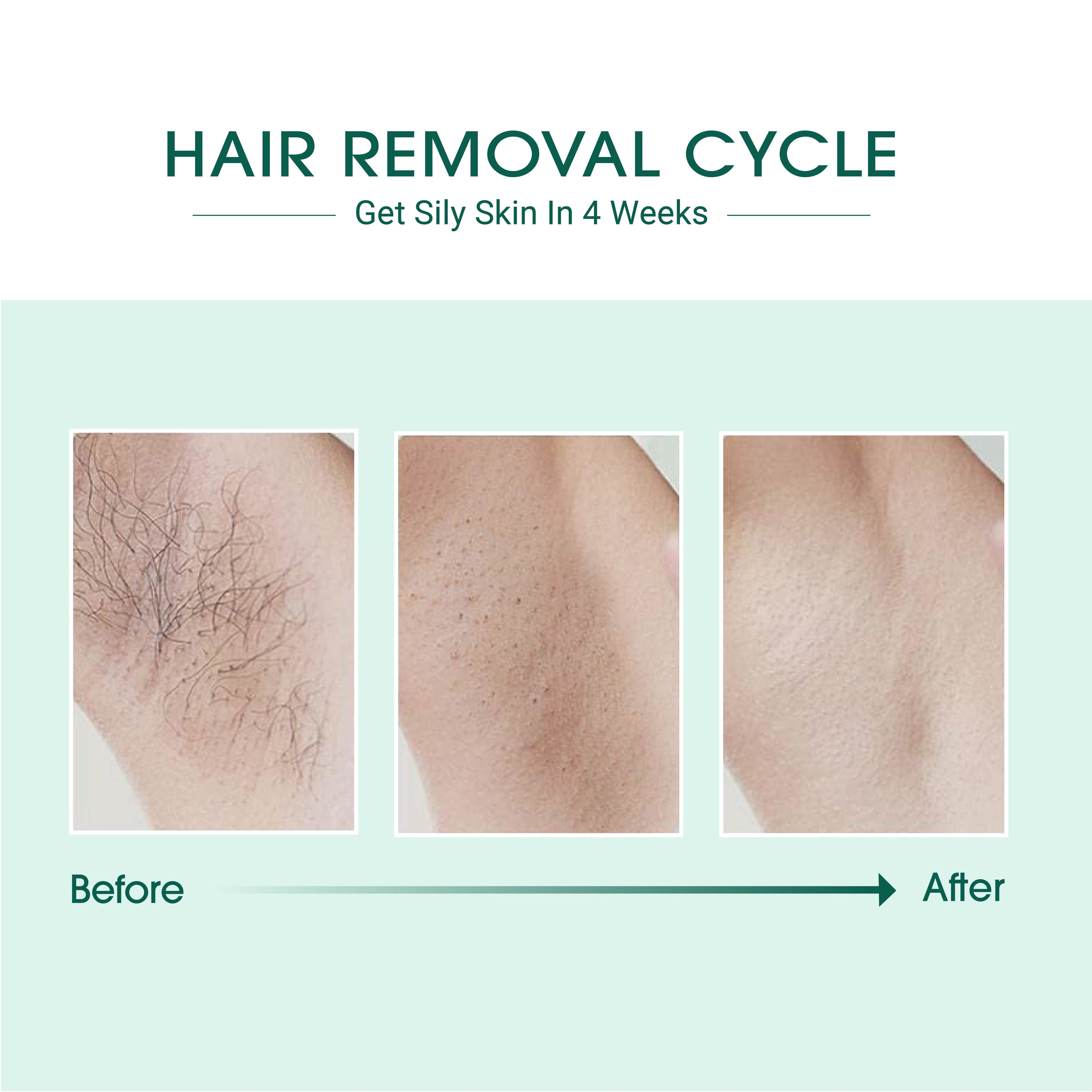 Laser IPL Hair Removal-3